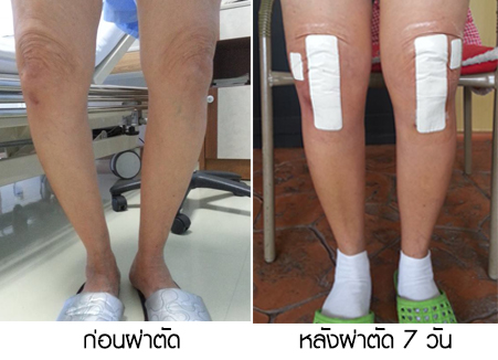 ผ่าตัดเปลี่ยนข้อเข่าเทียม