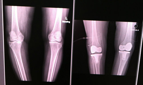 ผ่าตัดเปลี่ยนข้อเข่าเทียม