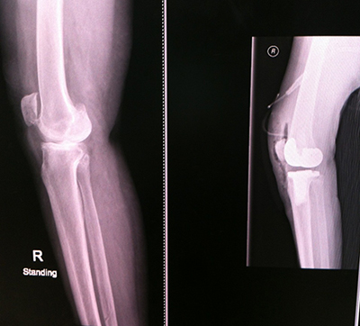 ผ่าตัดเปลี่ยนข้อเข่าเทียม