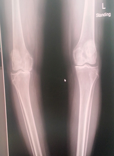 ผ่าตัดเปลี่ยนข้อเข่าเทียม