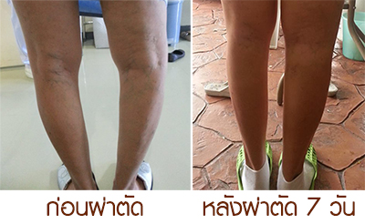 ผ่าตัดเปลี่ยนข้อเข่าเทียม