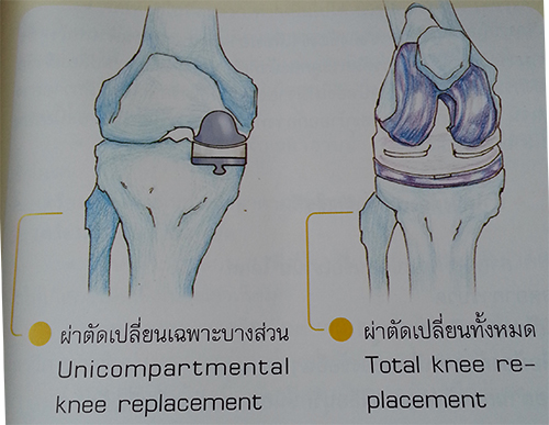 ผ่าตัดเปลี่ยนข้อเข่าเทียม