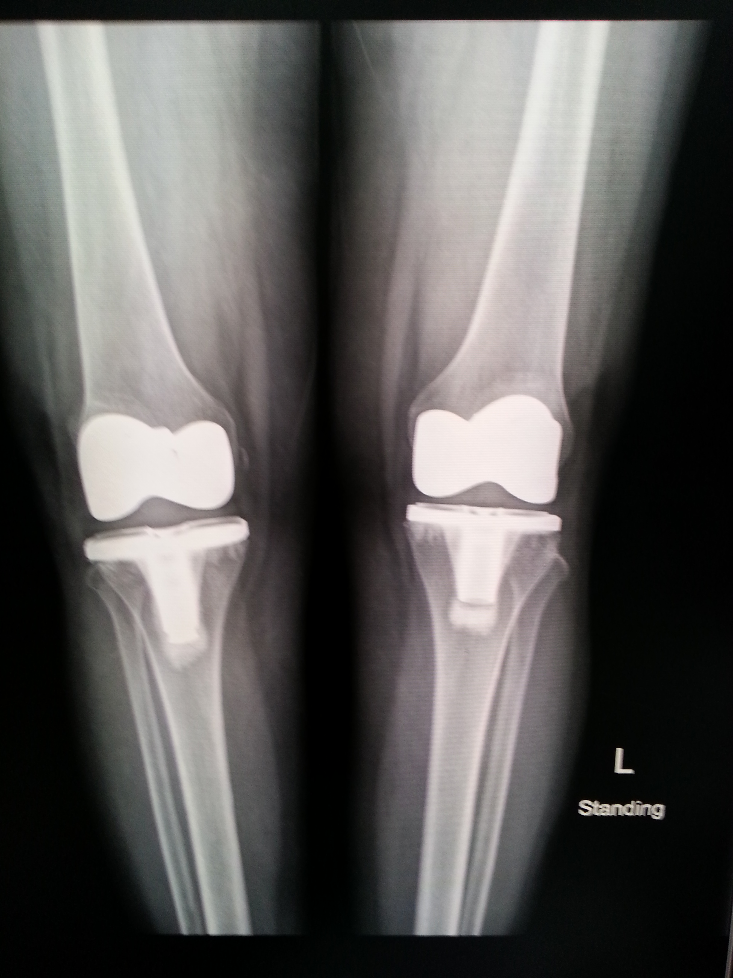 X-Ray ข้อเข่าเทียม (ุหลังผ่าตัด 6 เดือน)