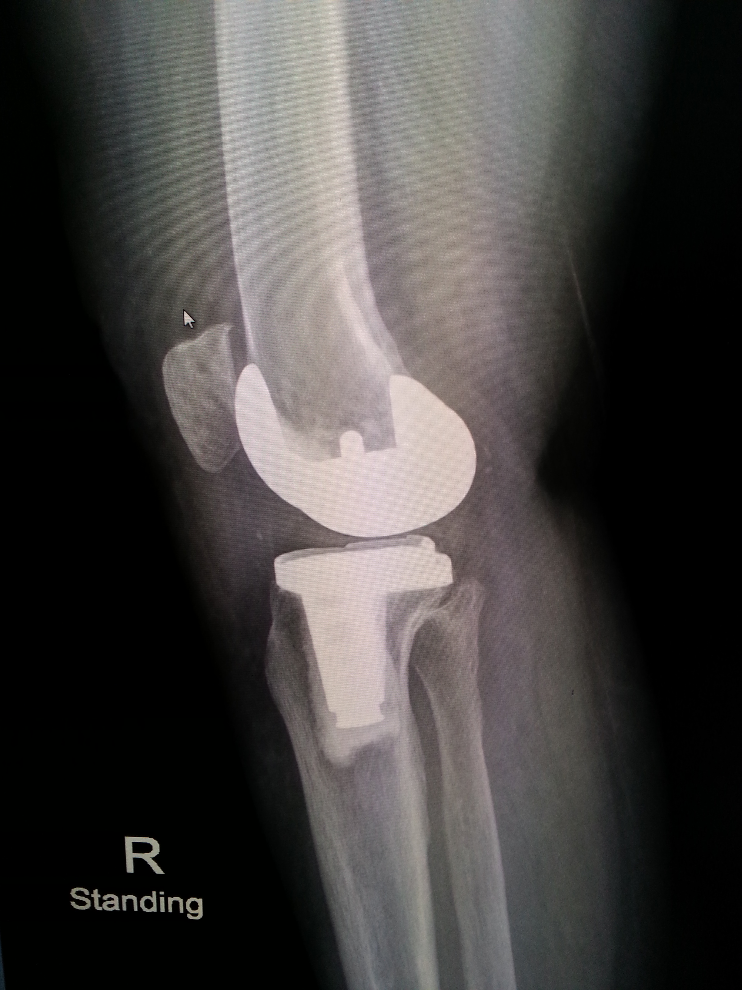X-Ray ข้อเข่าเทียม (ุหลังผ่าตัด 6 เดือน)