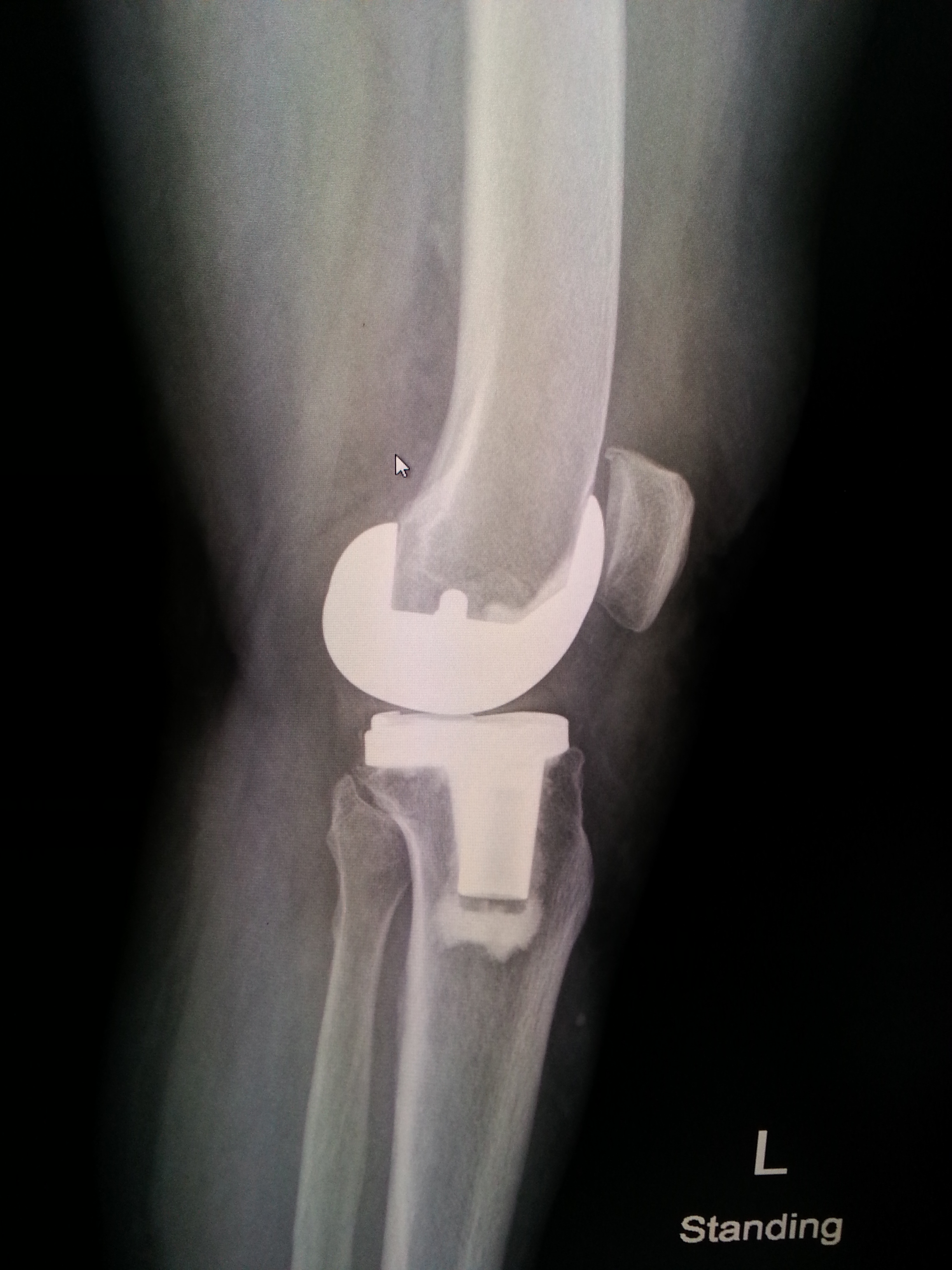 X-Ray ข้อเข่าเทียม (ุหลังผ่าตัด 6 เดือน)